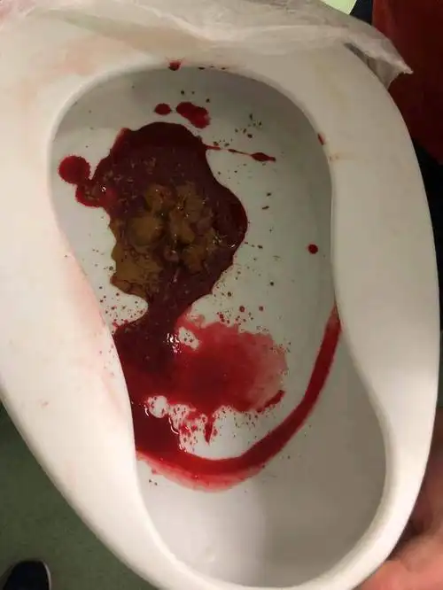 便血:溃疡性结肠炎和克罗恩病病情活动的表现(附图)