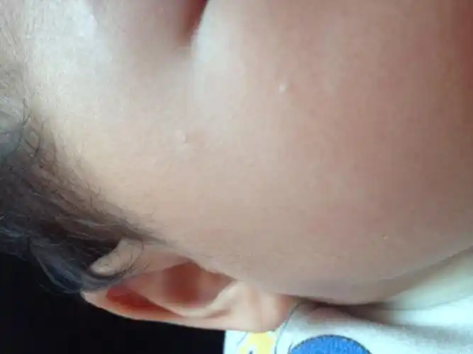 有那位宝妈知道这是什么吗?脸上一颗白白东西,不知道什么得?