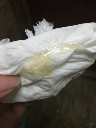 怀孕29周上小便时出现晶体一样的白带是怎么回事?