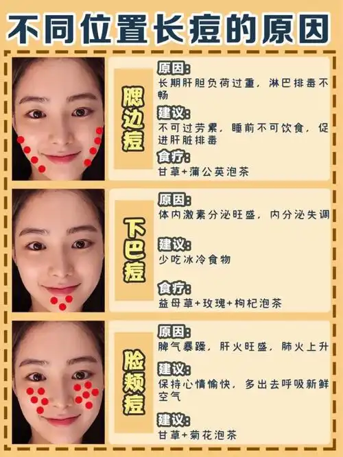 脸上长痘痘的位置丨脸部痘痘位置图解大全(脸上长痘痘的位置及其对应