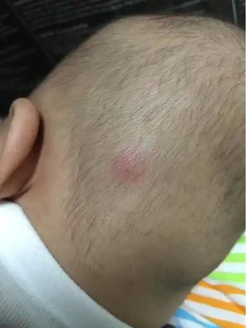 昨天发现宝宝头上有个小红包 今天包有点凸起来了 大家帮忙看看这是不