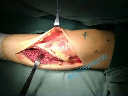 胫骨动脉瘤样骨囊肿病例分享 - 好大夫在线