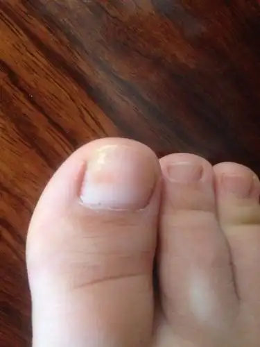 2006-08-22 为什么我的脚指甲上有比较明显的横纹 尤其是大脚趾 是不