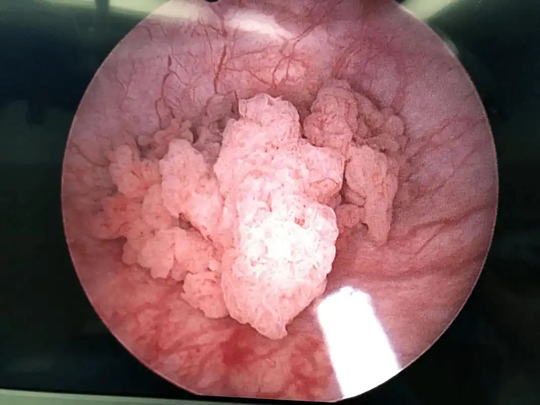 菜花样新生物膀胱肿瘤膀胱肿瘤是最常见的泌尿系统恶性肿瘤,也是全身