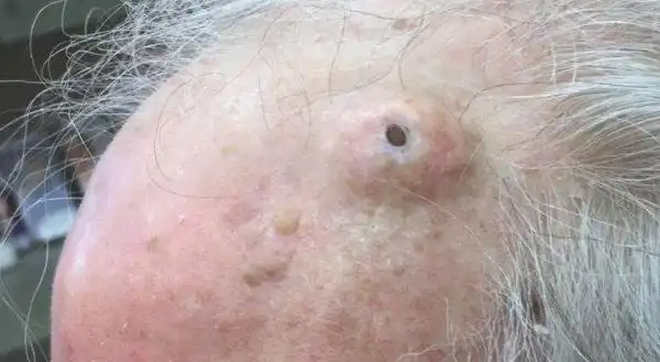 养了超久的陈年老黑头被挤出来的那瞬间真的是又恶心又纾压!