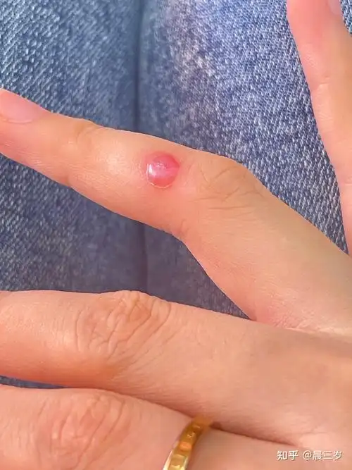 液氮冷冻治疗疣全过程 - 知乎