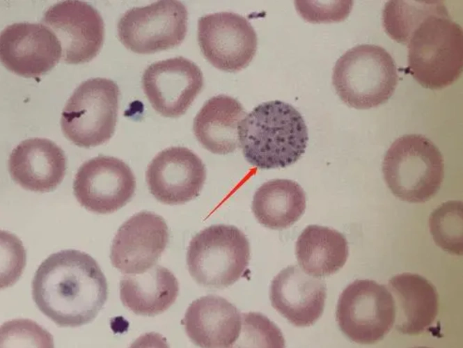 嗜碱性点彩红细胞