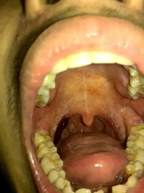 舌头长了个黑豆,咽喉边一条黑色充血的样子