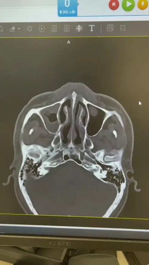 鼻骨粉碎性骨折鼻中隔骨折