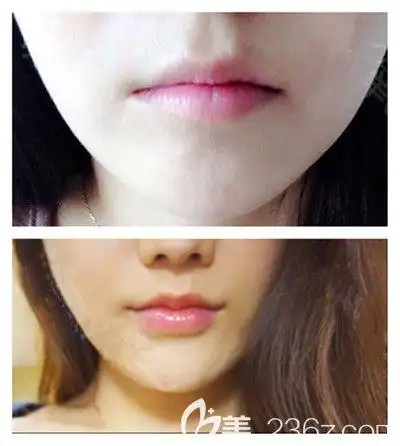 熟知m唇花瓣唇嘟嘟唇的区别并从术后效果图了解哪个更好看和适合你