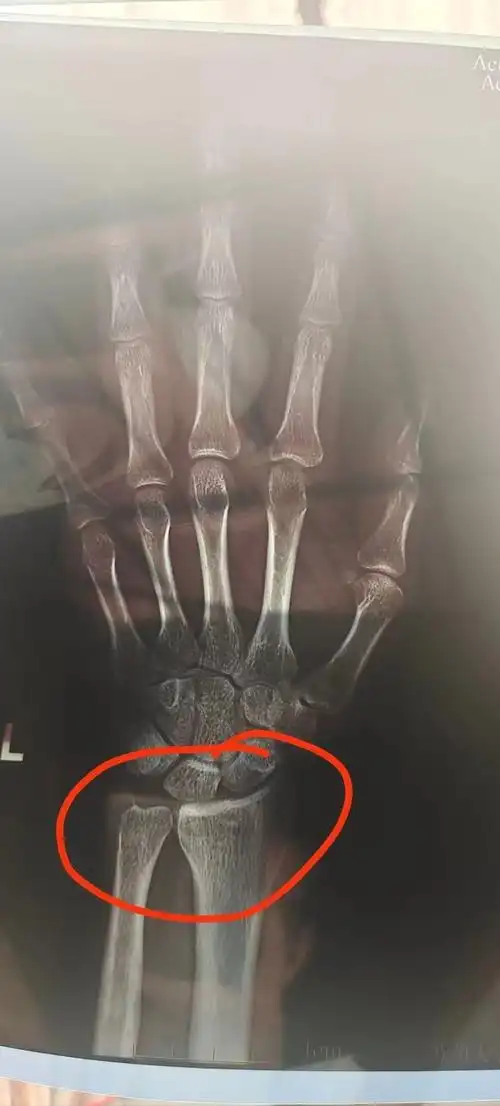 麻烦各位大佬看下这个片子骨龄多大要具体的数字骨骺线是不是闭合了