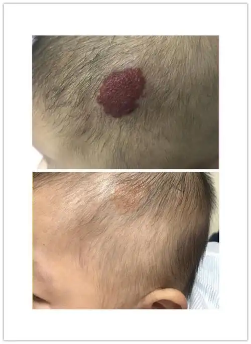 血管瘤哪家医院看的好,治疗血管瘤哪个医生好,血管瘤推荐医院医生_好