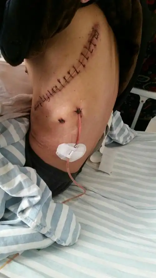 这是开胸方式食管癌手术的伤口,长度约25cm.