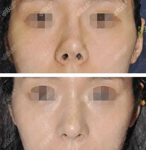 隆鼻鼻小柱挛缩怎么办?韩国4月31整形医院修复鼻挛缩怎么样?