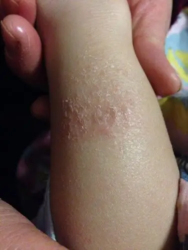 1岁半宝宝,小腿上,之前是一小块皮肤起皮,以为干燥造成,只用护肤,最近