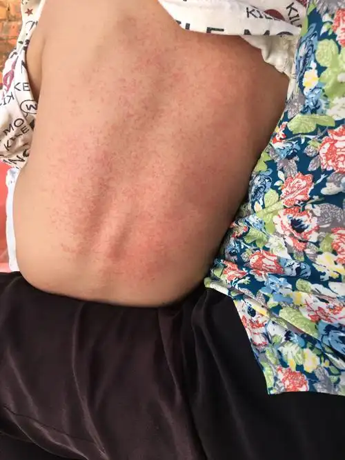 这个不是痱子,因为都十月份了,天气都不热了.