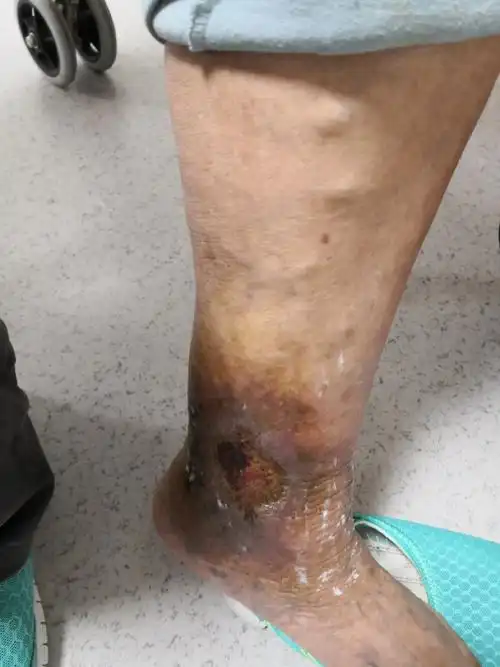 下肢静脉曲张导致的淤积性皮炎,皮肤溃疡症状.