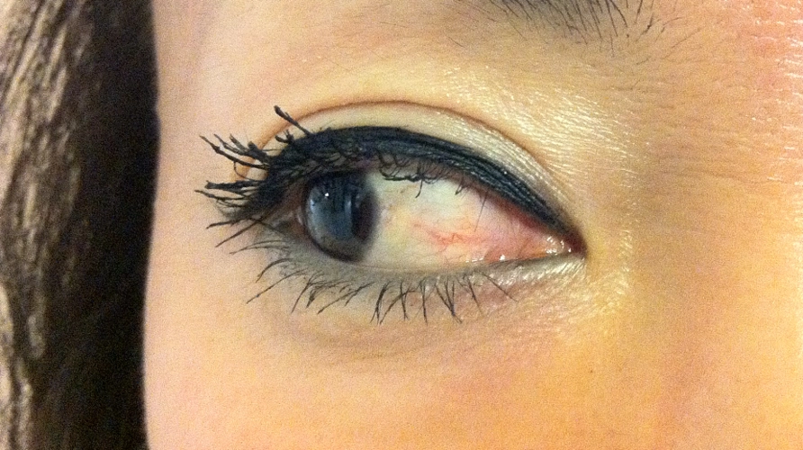 眼睛红血丝是什么病改怎么治疗